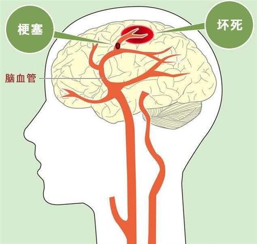 腦血栓腦梗死的自然療法技術(shù)原理